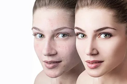 Gutschein Spezielle Behandlung für unreine Haut