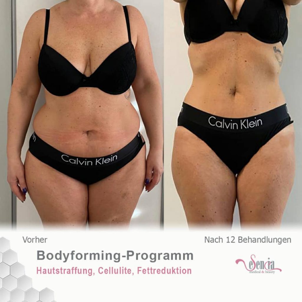 Bodyforming – eSenCia Medical & Beauty