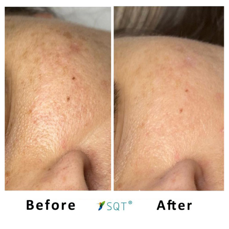 Bio-Microneedling2-768x768