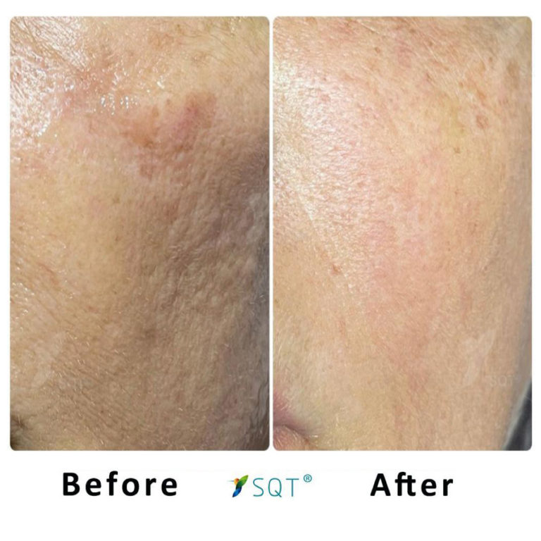 Bio-Microneedling4-768x768