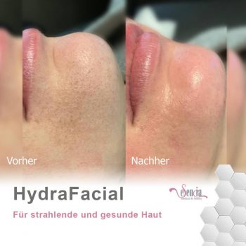 hydrafacil